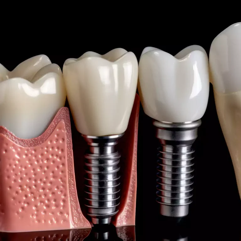 best dental implants treatment in chennai